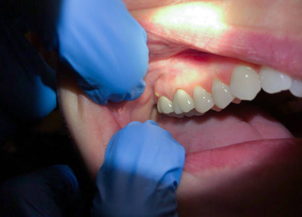 Best Emergency Dental Care for Abscessed Tooth in Morrilton, AR
